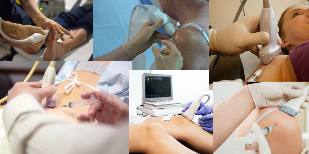 Formation complète : Infiltration Ostéo Articulaire sous guidage échographique